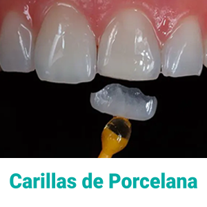 carillas-de-porcelana