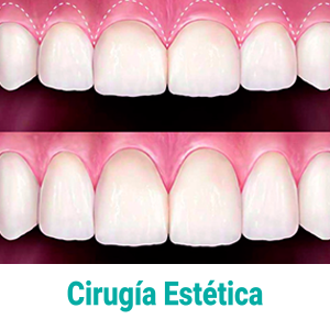 cirugia-estetica-periodontal