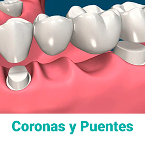 coronoas-y-puentes-dentales