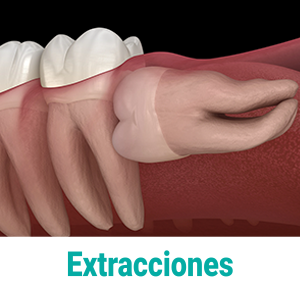 extraccion-dental