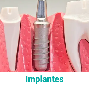 implante-dental